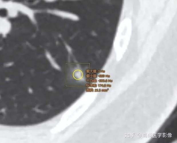 新澳今天最新消息和抗癌2年后发现误诊与抗癌2年后发现误诊怎么办
